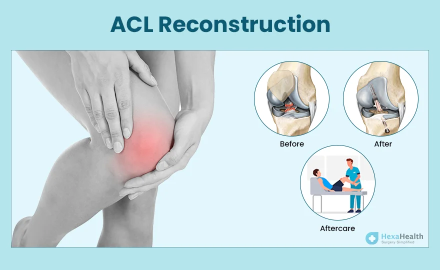 ACL Reconstruction Surgery Cost in Noida India