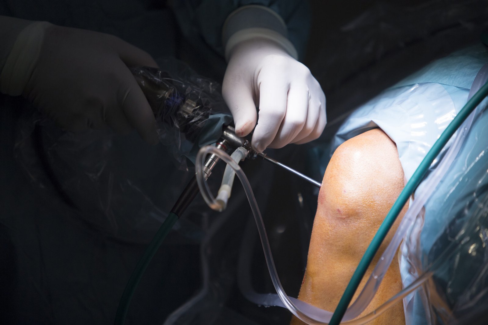 Arthroscopy Surgery in Ghaziabad