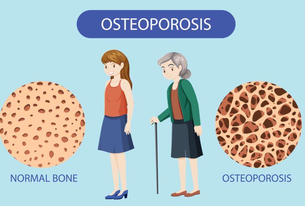 Osteoporosis