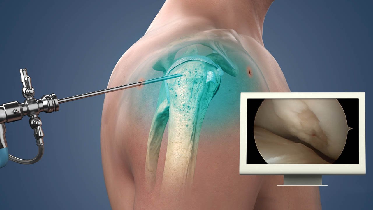 Arthroscopy Cost in India