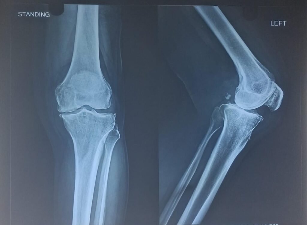 PARTIAL Knee Replacement