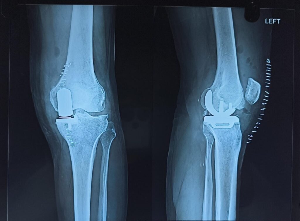 PARTIAL Knee Replacement