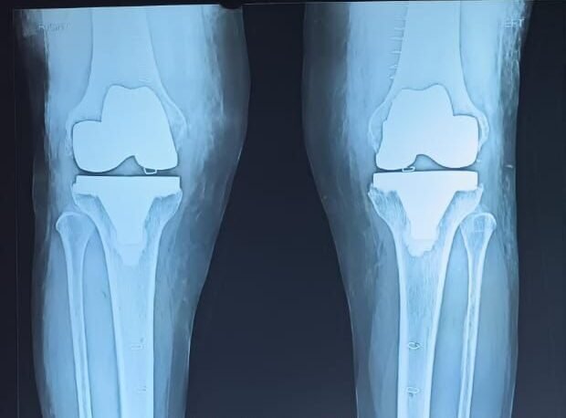 Knee Replacement SURGERY