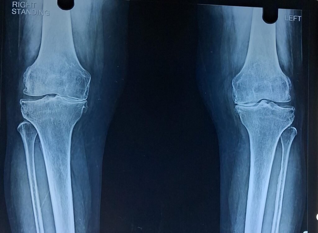Knee Replacement SURGERY