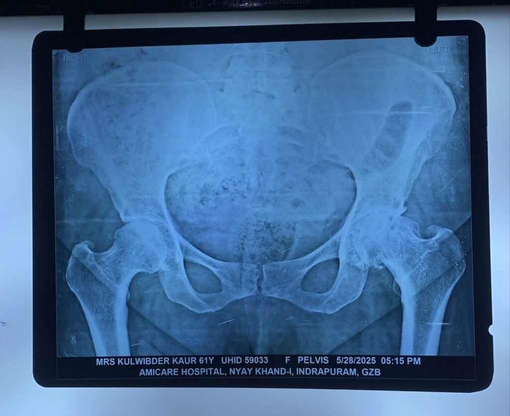 HIP Replacement SURGERY