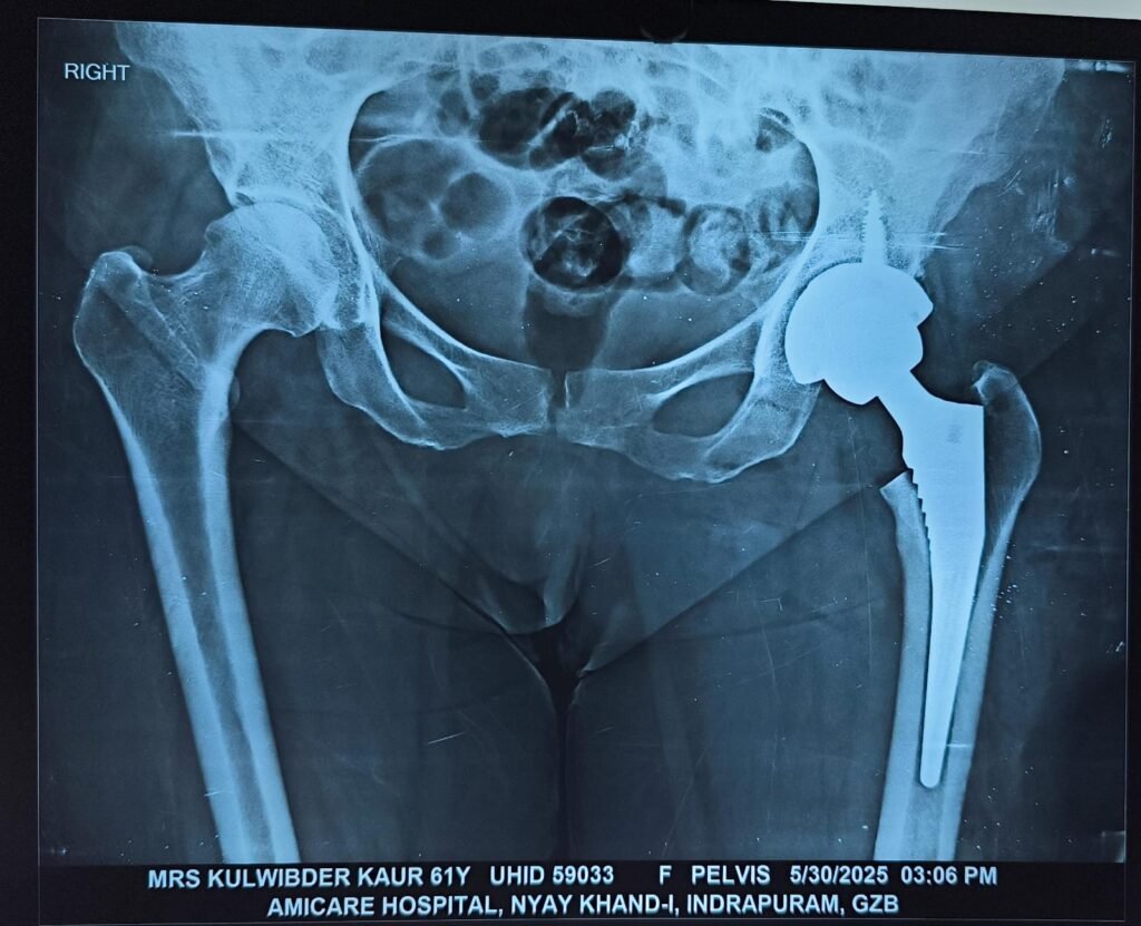 HIP Replacement SURGERY