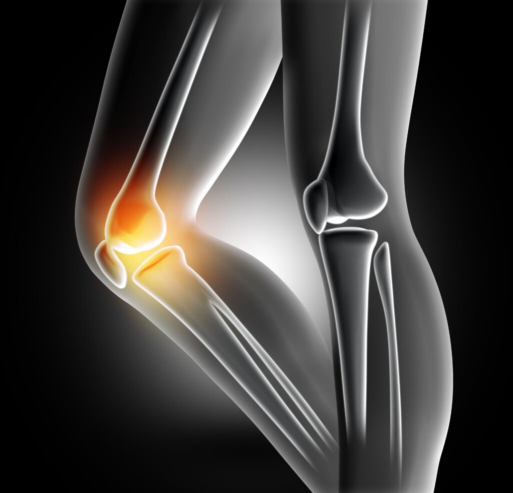Osteoarthritis symptoms
