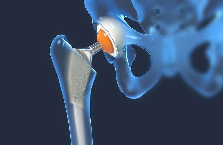 Types of Hip Replacement Surgery