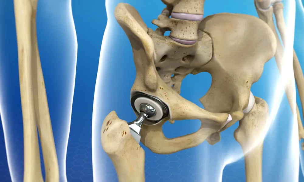 Bipolar Hip Replacement