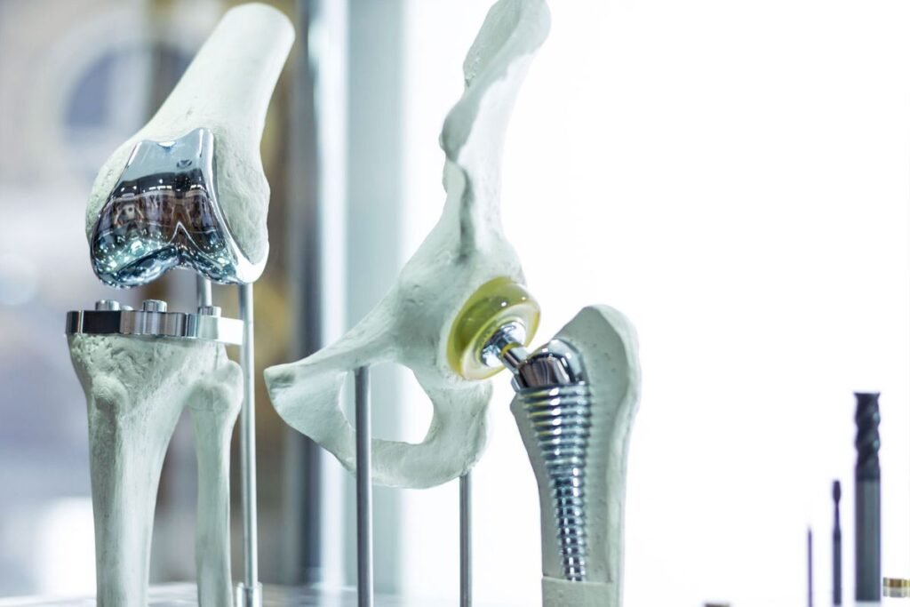 Titanium Knee Replacement