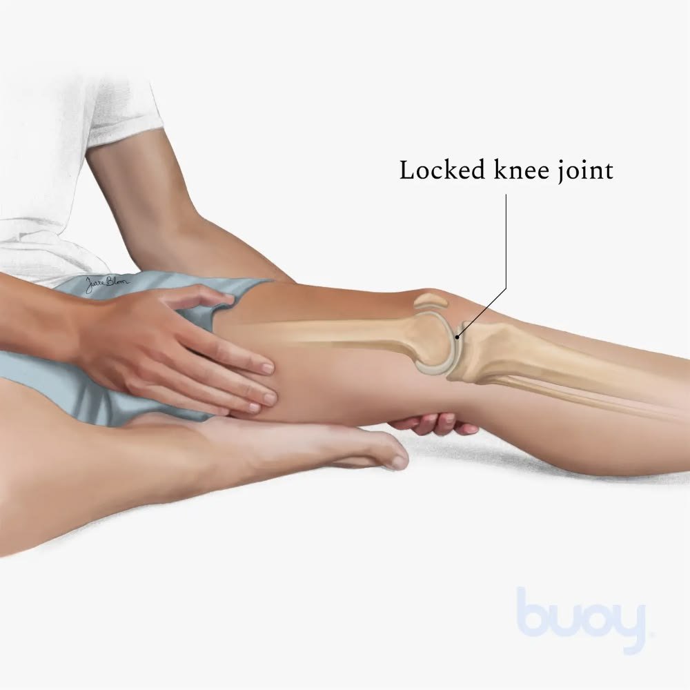 Locked Knee: Causes, Symptoms & Treatment Guide