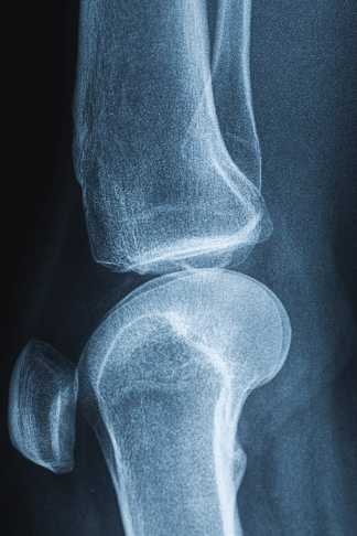 PCL Avulsion Fracture