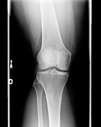 PCL Avulsion Fracture