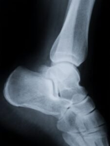 X-Ray Image of Human Foot Bone