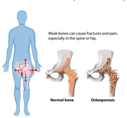 Osteoporosis Treatment