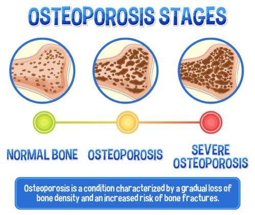 Common Causes of Osteoporosis